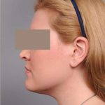 Neck Liposuction / Chin Liposuction Before & After Patient #1864