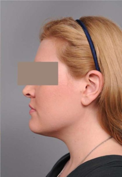 Neck Liposuction / Chin Liposuction Before & After Patient #1864