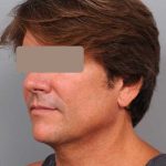 Neck Liposuction / Chin Liposuction Before & After Patient #1877