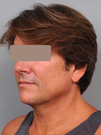 Neck Liposuction / Chin Liposuction Before & After Patient #1877