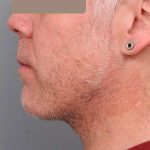 Neck Liposuction / Chin Liposuction Before & After Patient #1886