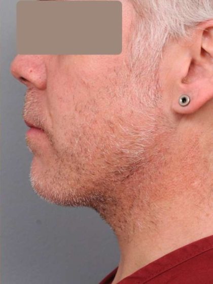 Neck Liposuction / Chin Liposuction Before & After Patient #1886
