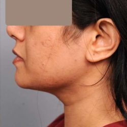 Neck Liposuction / Chin Liposuction Before & After Patient #1893