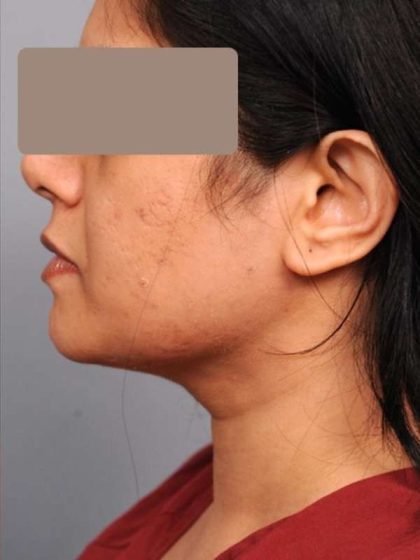 Neck Liposuction / Chin Liposuction Before & After Patient #1893