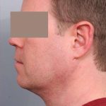 Neck Liposuction / Chin Liposuction Before & After Patient #1900