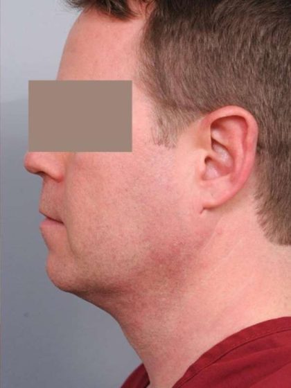 Neck Liposuction / Chin Liposuction Before & After Patient #1900