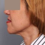 Neck Liposuction / Chin Liposuction Before & After Patient #1905