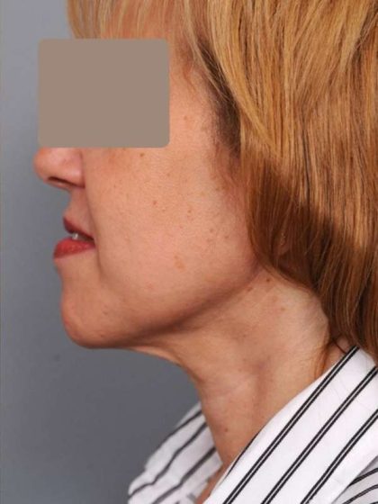 Neck Liposuction / Chin Liposuction Before & After Patient #1905