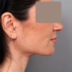 Neck Liposuction / Chin Liposuction Before & After Patient #1913