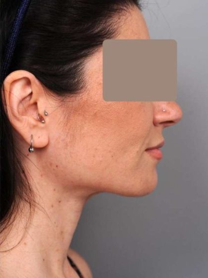 Neck Liposuction / Chin Liposuction Before & After Patient #1913