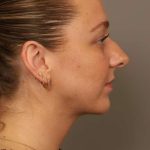 Neck Liposuction / Chin Liposuction Before & After Patient #1923