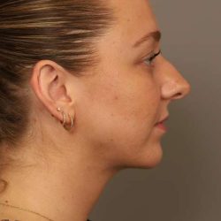 Neck Liposuction / Chin Liposuction Before & After Patient #1923