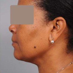 Neck Liposuction / Chin Liposuction Before & After Patient #1930