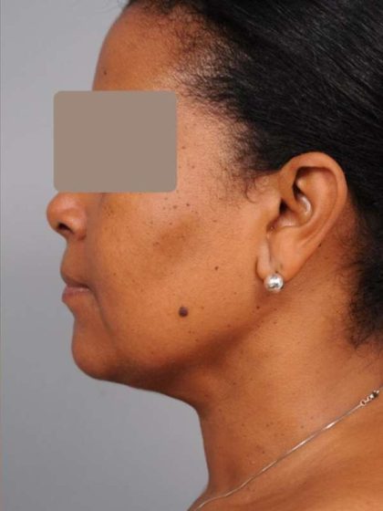Neck Liposuction / Chin Liposuction Before & After Patient #1930