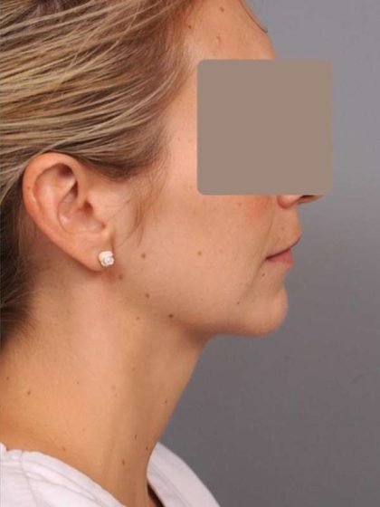 Neck Liposuction / Chin Liposuction Before & After Patient #1937
