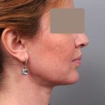 Neck Liposuction / Chin Liposuction Before & After Patient #1946