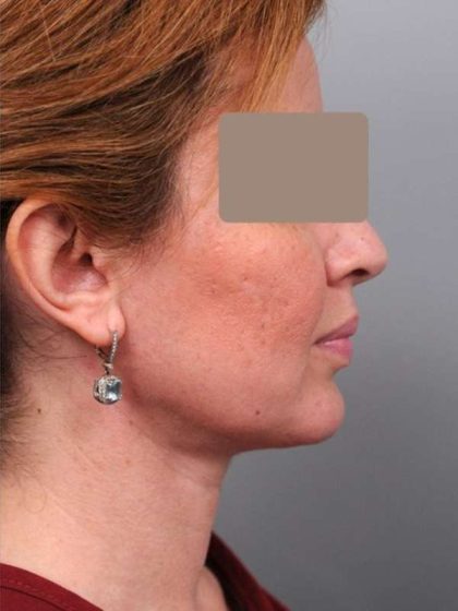 Neck Liposuction / Chin Liposuction Before & After Patient #1946