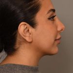 Neck Liposuction / Chin Liposuction Before & After Patient #1953