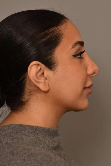 Neck Liposuction / Chin Liposuction Before & After Patient #1953