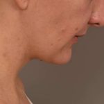 Neck Liposuction / Chin Liposuction Before & After Patient #1967