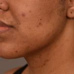 Neck Liposuction / Chin Liposuction Before & After Patient #1978