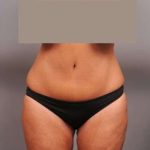 Tummy Tuck Before & After Patient #402