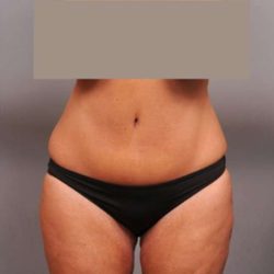 Tummy Tuck Before & After Patient #402
