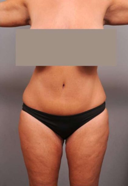 Tummy Tuck Before & After Patient #402