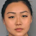 Neck Liposuction / Chin Liposuction Before & After Patient #2011