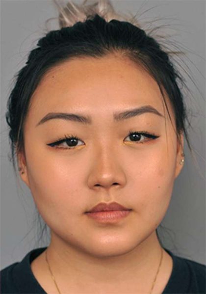 Neck Liposuction / Chin Liposuction Before & After Patient #2011