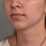 Neck Liposuction / Chin Liposuction Before & After Patient #2020