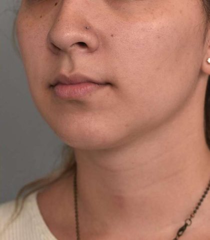 Neck Liposuction / Chin Liposuction Before & After Patient #2020