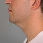Neck Liposuction / Chin Liposuction Before & After Patient #2027