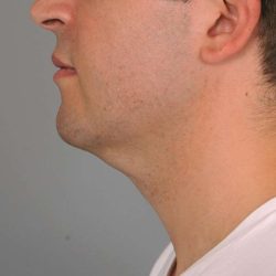 Neck Liposuction / Chin Liposuction Before & After Patient #2027
