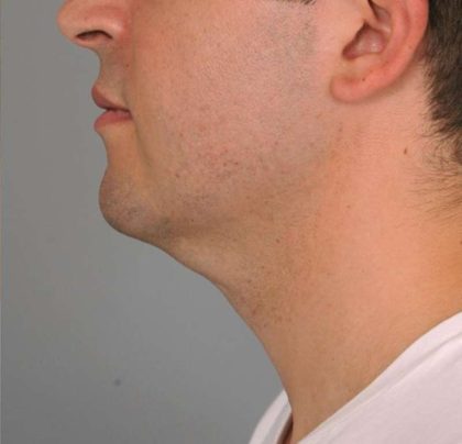 Neck Liposuction / Chin Liposuction Before & After Patient #2027
