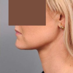 Neck Liposuction / Chin Liposuction Before & After Patient #2034