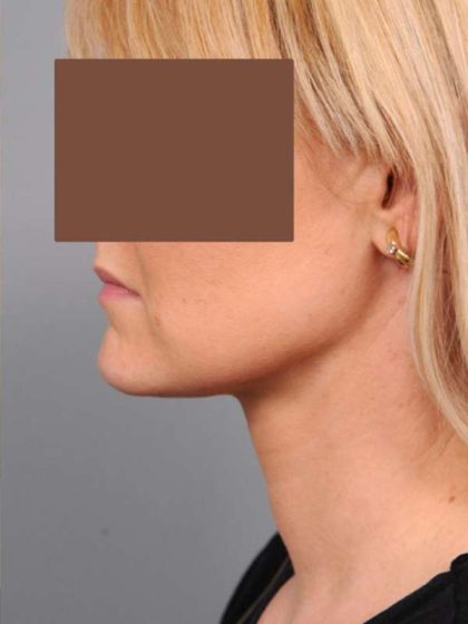 Neck Liposuction / Chin Liposuction Before & After Patient #2034