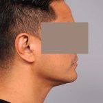 Neck Liposuction / Chin Liposuction Before & After Patient #2039