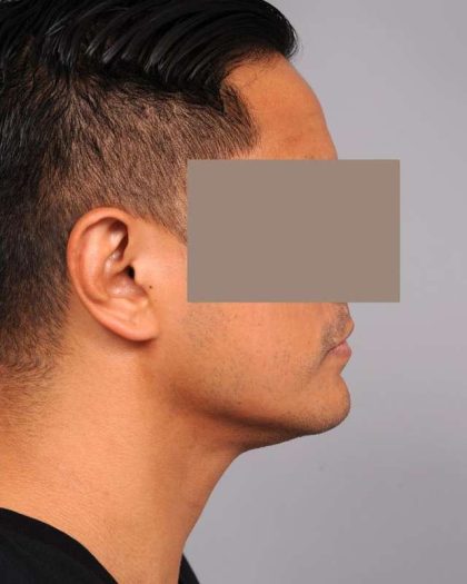 Neck Liposuction / Chin Liposuction Before & After Patient #2039