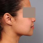 Neck Liposuction / Chin Liposuction Before & After Patient #2046
