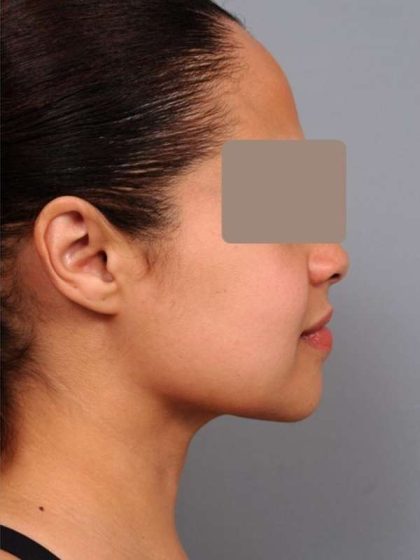 Neck Liposuction / Chin Liposuction Before & After Patient #2046