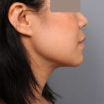 Neck Liposuction / Chin Liposuction Before & After Patient #2051
