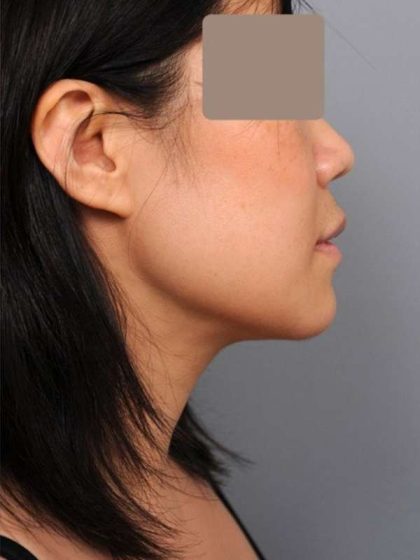 Neck Liposuction / Chin Liposuction Before & After Patient #2051