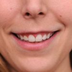 Gummy Smile Before & After Patient #2054