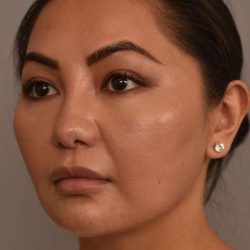 Buccal Fat Removal Before & After Patient #2063