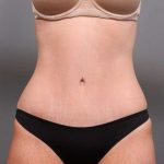 Tummy Tuck Before & After Patient #411