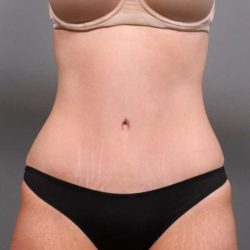 Tummy Tuck Before & After Patient #411