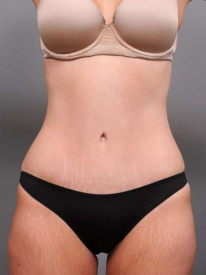 Tummy Tuck Before & After Patient #411