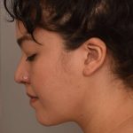 Buccal Fat Removal Before & After Patient #2071