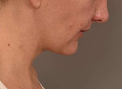 Buccal Fat Removal Before & After Patient #2080